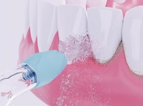 歯茎に口腔洗浄器を当てる様子